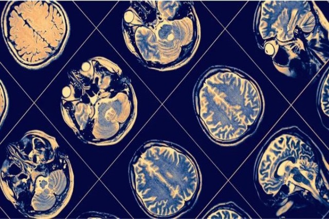 Një simptomë e ngjashme e trurit shihet tek të moshuarit me obezitet dhe njerëzit me Alzheimer