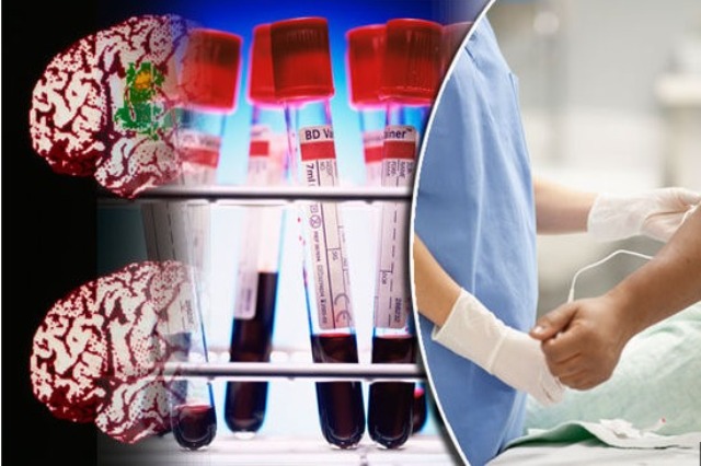 Testi i gjakut mund të zbulojë sëmundjen e Alzheimerit vite përpara se të shfaqen simptomat