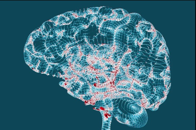 Ilaçi i parë në botë i Alzheimerit është një hap më afër përdorimit