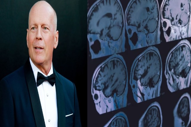 Çfarë është demenca frontotemporale nga e cila vuan Bruce Willis?
