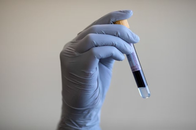 Testi i ri i gjakut mund të zbulojë sëmundjen e Alzheimerit vite përpara diagnozës